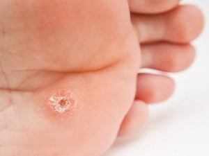 Plantar Warts Commonly Mistaken for Corns and Calluses