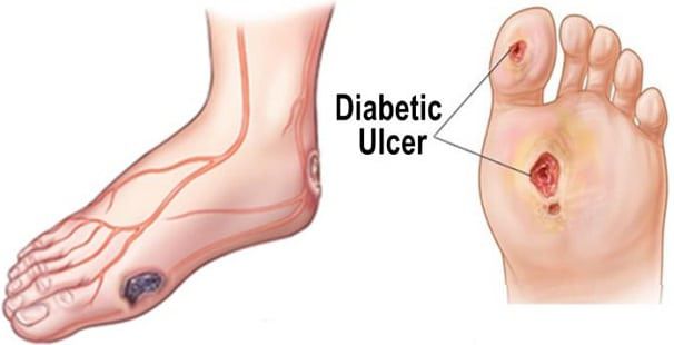 Diabetes And How It Affects Our Feet